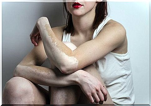 1-vitiligo arms