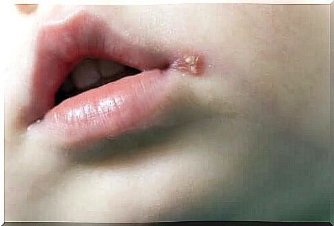 Children with cold sores.