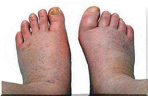 6 remedies for swelling in the legs, ankles and feet