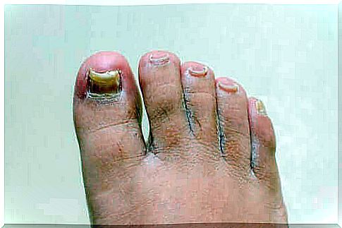 Do onychomycosis preparations work on the hands and feet?