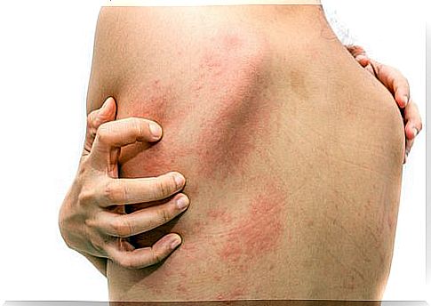 Home treatments for hives