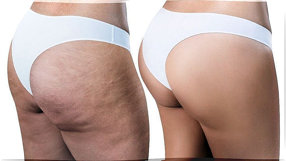 Learn how to eliminate cellulite with effective and simple homemade remedies