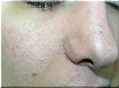 Natural solutions for blackheads, warts and pimples