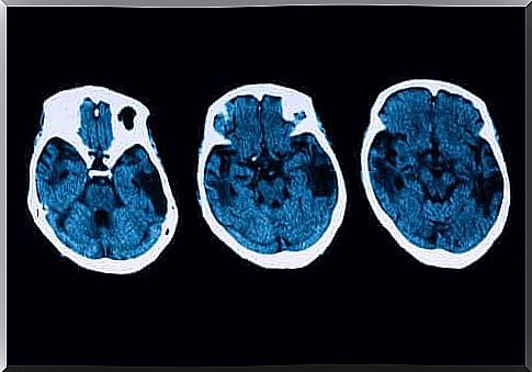 Posterior cortical atrophy - diagnosis and treatment