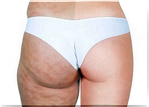 2-cellulite-before-and-after