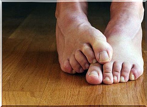 Six natural remedies for athlete's foot