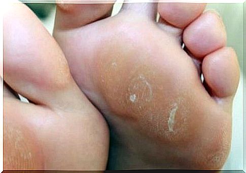 Treat slave and hard skin with 4 remedies