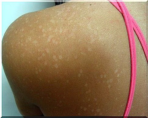 What causes white spots on the skin?