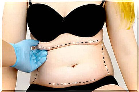 What is tummy tuck, or tummy tuck?